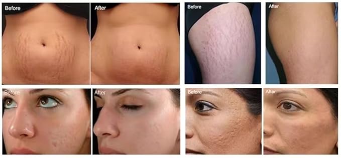 Anti-Aging Device, Wrinkle Reduction Beauty Care Equipment